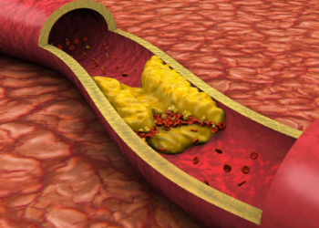 Nivelet e kolesterolit ulen në verë dhe rriten në dimër